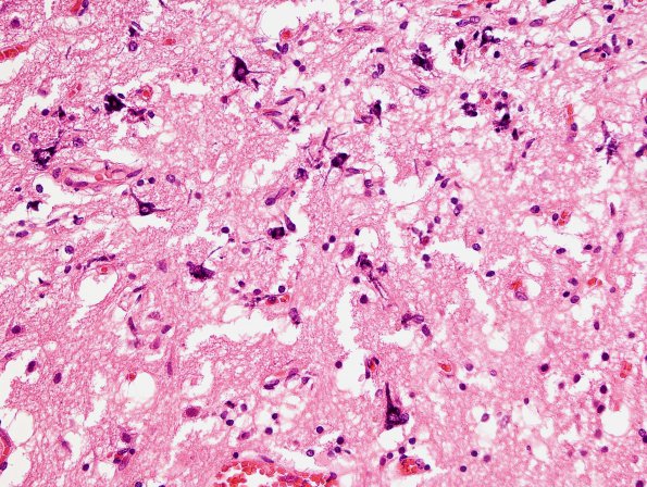 4 Neurons, mineralized, hypoxia-ischemia (Case 5) H&E 2