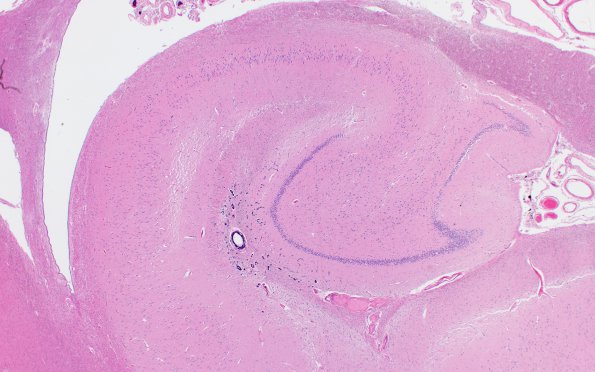 10A1 Calcifications, hippocampal (Case 12) H&E 2X 70yo