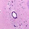 10A3 Calcifications, hippocampal (Case 12) H&E 10X