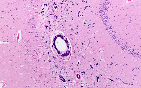 10A3 Calcifications, hippocampal (Case 12) H&E 10X