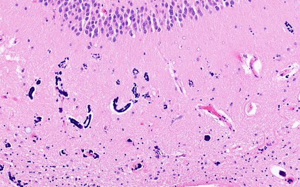 10A4 Calcifications, hippocampal (Case 12) H&E 20X