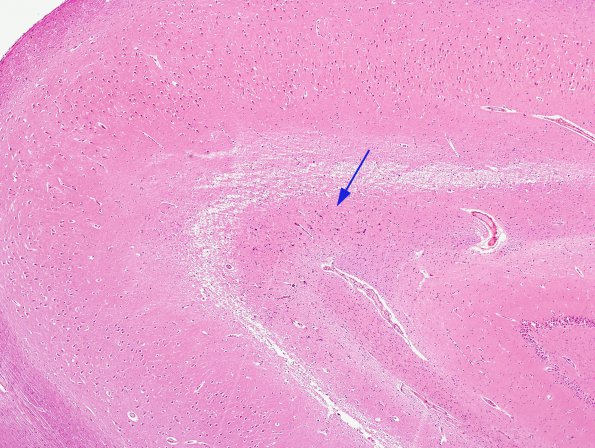 1A1 Pre-Calcifications, hippocampus (Case 6) H&E 2