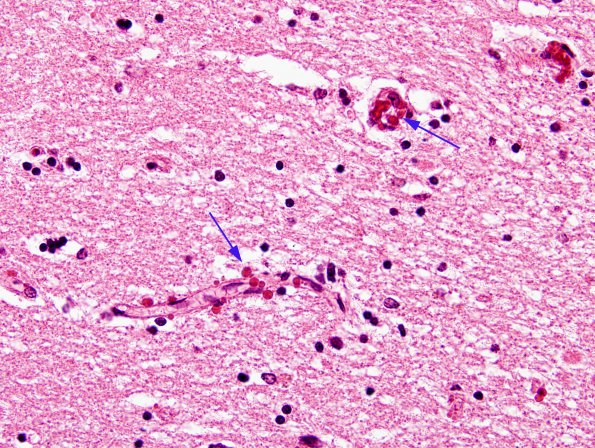 1A2 Pre-Calcifications, hippocampus (Case 6) H&E 5