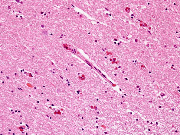 4 1A3 Pre-Calcifications, hippocampus (Case 6) H&E 8