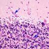 1A4 Calcifications, cerebellum (Case 6)