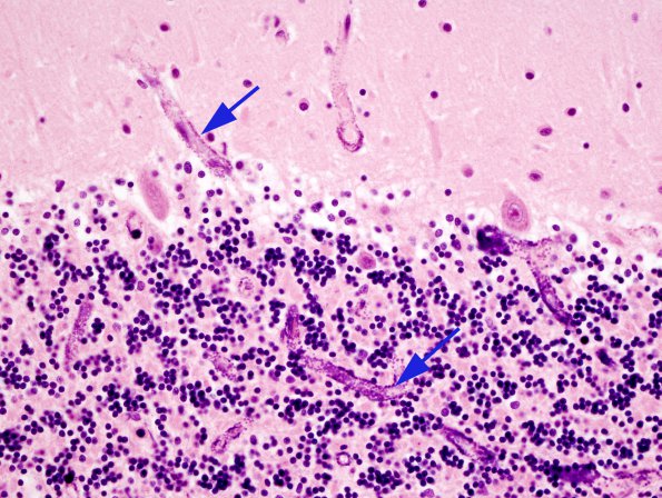 1A4 Calcifications, cerebellum (Case 6)