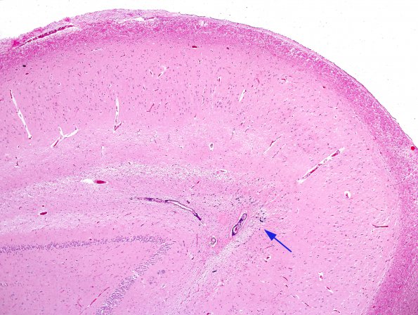 2A1 Calcification, hippocampus (Case 2) H&E 1