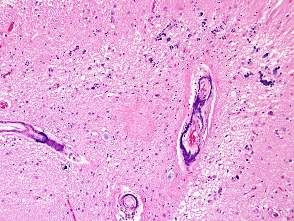 2A2 Calcification, hippocampus (Case 2) H&E 2