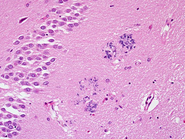 2A3 Calcification, hippocampus (Case 2) H&E 4