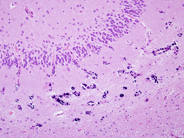 3 Calcification, hippocampus (Case 4) H&E 2