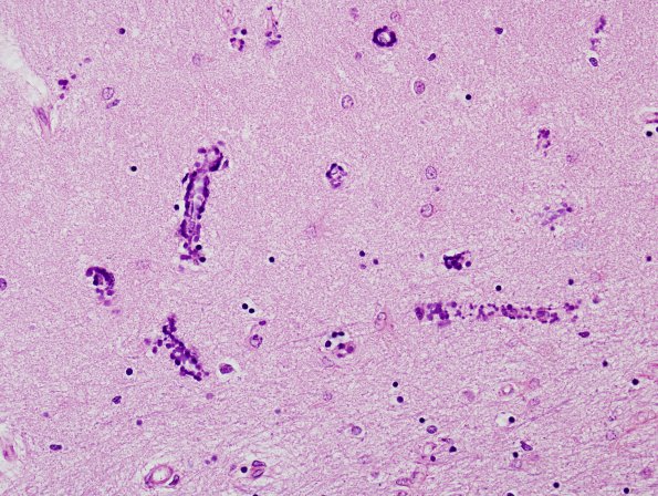 4 Calcification, hippocampus (Case 1) H&E 5