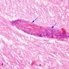 5 Calcifications, perivascular (Case 10) H&E