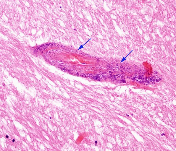 5 Calcifications, perivascular (Case 10) H&E