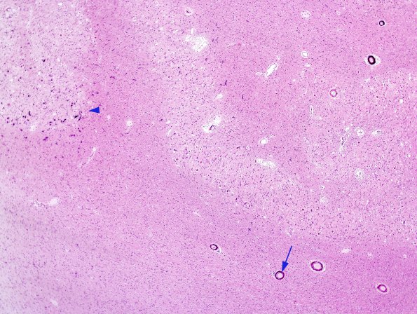 6A1 Calcifications, idiopathic (Case 3) cbell dentate nucleus H&E 6