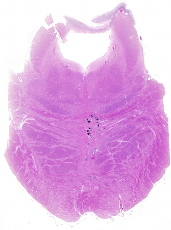 6A2 Calcifications, idiopathic (Case 3) pons H&E 0 whole mount