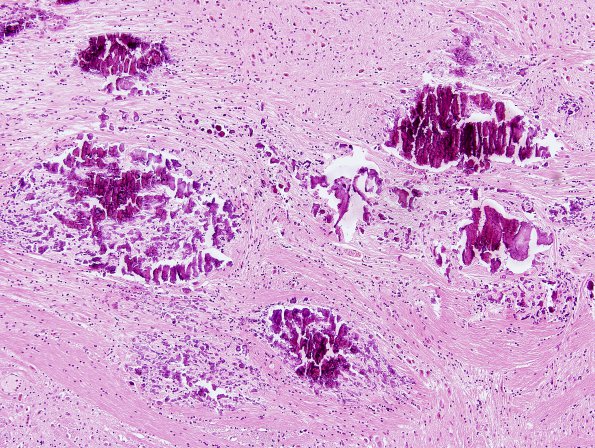 6A3 Calcifications, idiopathic (Case 3) pons H&E 2