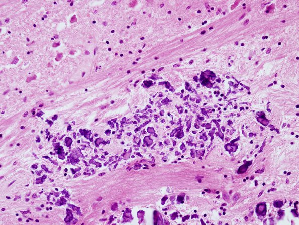 6A3 Calcifications, idiopathic (Case 3) pons H&E 5