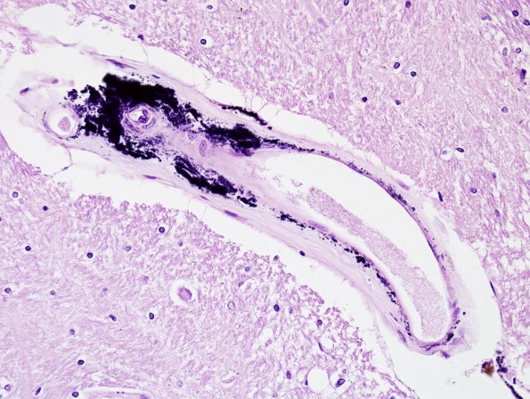 7 Calcification, basal ganglia (Case 5) H&E 1.