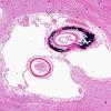 8 Calcifications, vessels, basal ganglia (Case 9) H&E 2