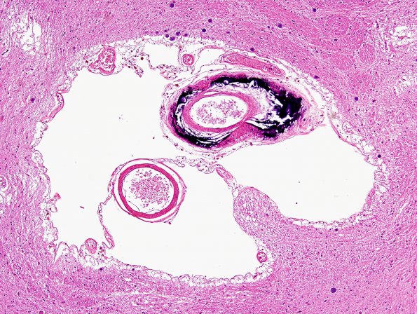 8 Calcifications, vessels, basal ganglia (Case 9) H&E 2