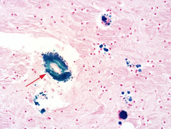 9A1 Vessel, Mineralized, basal ganglia (Case 11) 20X Iron 1