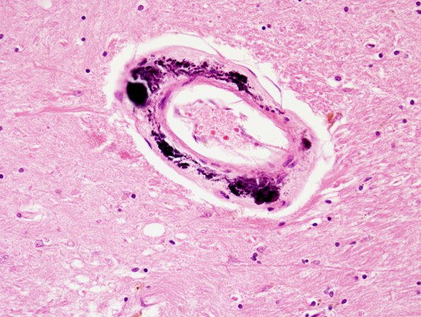 9A2 Vessel, Mineralized, basal ganglia (Case 11) 40X H&E