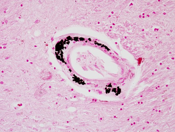 9A3 Vessel, Mineralized, basal ganglia (Case 11) 40X Von Kossa