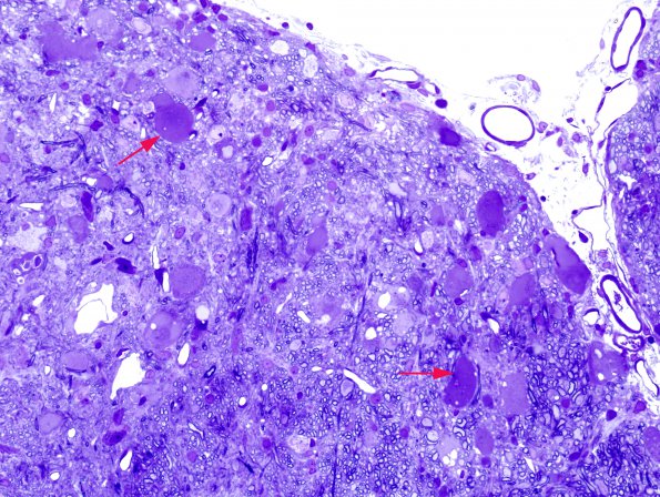 10A2 Neuroaxonal Dystrophy (NAD) Aged Mouse Gracile Nucleus Plastic 3