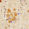 12 Neuroaxonal dystrophy (Case 14), Gracile, Ubiquitin  A