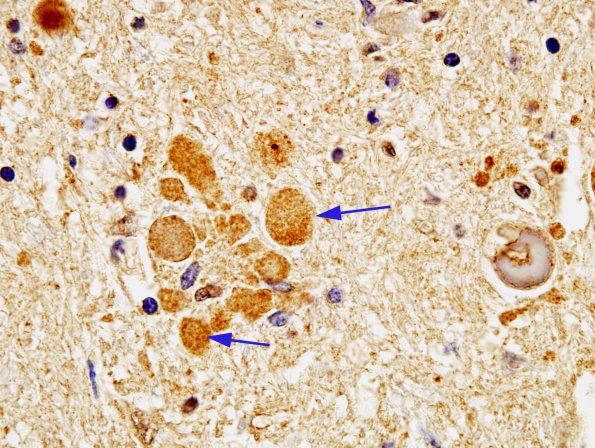 12 Neuroaxonal dystrophy (Case 14), Gracile, Ubiquitin  A