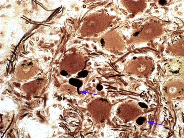 15 Neuroaxonal dystrophy, SMG, diabetic human Biels 2