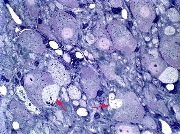 16 Neuroaxonal dystrophy, superior mesenteric ganglion, diabetic mouse