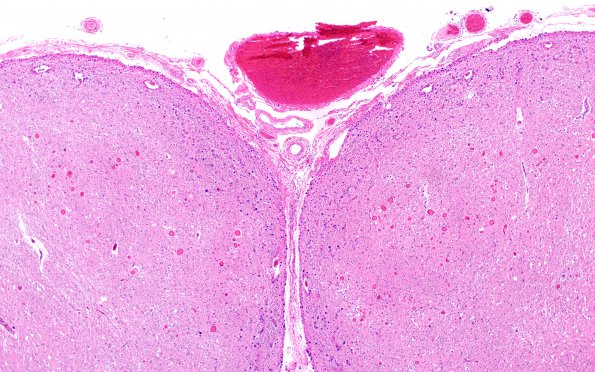 19A1 Neuroaxonal dystrophy NAD & Corpora amylacea (Case 27) Gracile H&E 6