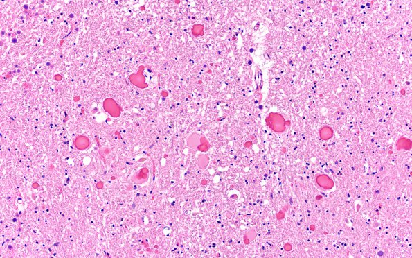 19A2 Neuroaxonal dystrophy NAD & Corpora amylacea (Case 27) Gracile H&E 3