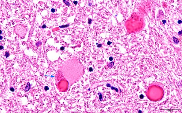 19A3 Neuroaxonal dystrophy NAD & Corpora amylacea (Case 27) Gracile H&E 3