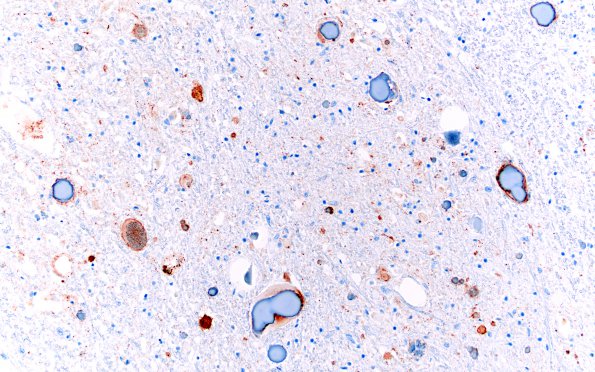 19D1 NAD (Case 27, N8) Chromogranin 3