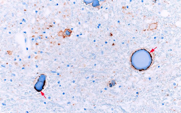 19D2 NAD (Case 27, N8) Chromogranin 1 copy