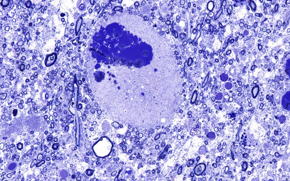 19E1 Neuroaxonal dystrophy NAD & Corpora amylacea (Case 27) Gracile Plastic 100X 9