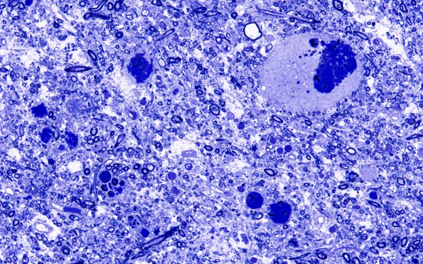 19E2 Neuroaxonal dystrophy NAD (Case 27) Gracile Plastic 7