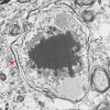 19F1 Neuroaxonal Dystrophy, Gracile (Case 27) EM 022 - Copy copy