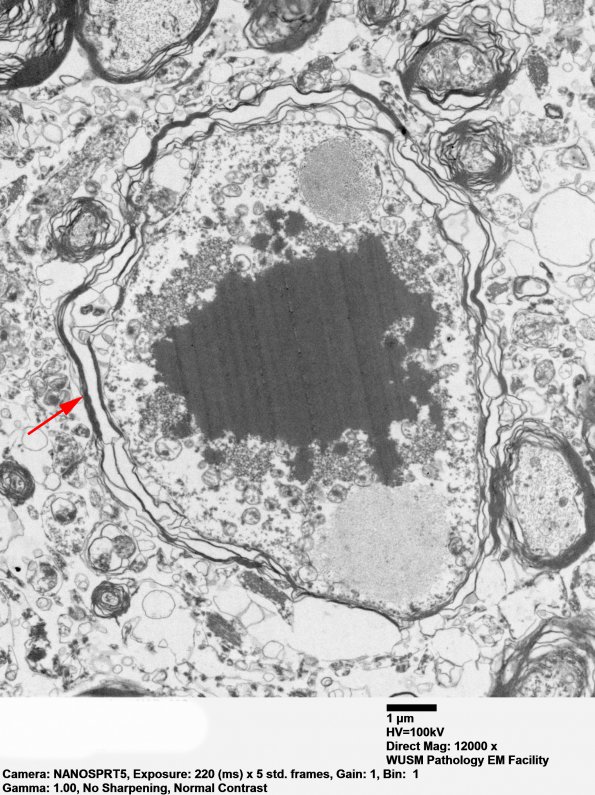 19F1 Neuroaxonal Dystrophy, Gracile (Case 27) EM 022 - Copy copy