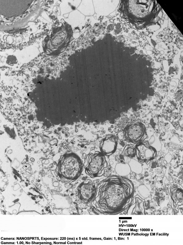 19F2 Neuroaxonal Dystrophy, Gracile (Case 27) EM 026 - Copy