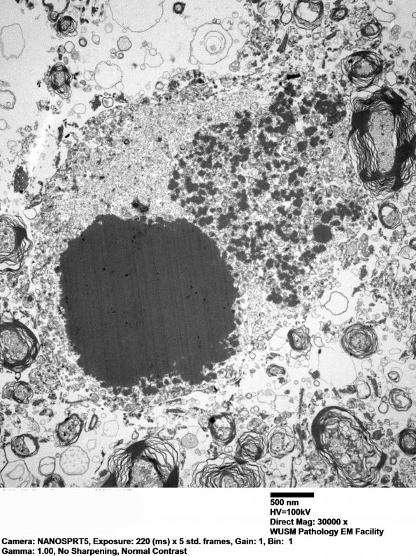 19F3 Neuroaxonal Dystrophy, gracile (Case 27) EM 007 - Copy