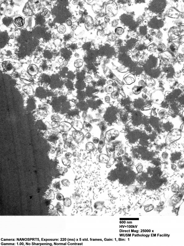 19F4 Neuroaxonal Dystrophy, Gracile (Case 27) EM 009 - Copy