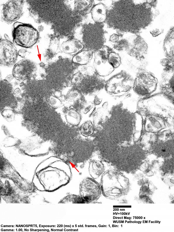 19F5 Neuroaxonal Dystrophy, Gracile (Case 27) EM 012 - Copy copy