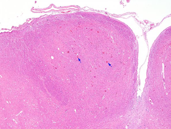 1A1 Neuroaxonal dystrophy, gracile (Case 3) H&E 6