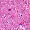 1A2 Neuroaxonal dystrophy (Case 3) H&E 1