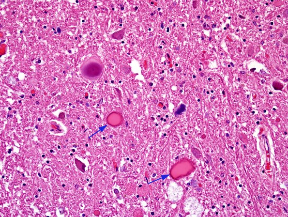 1A2 Neuroaxonal dystrophy (Case 3) H&E 1