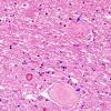 2 Neuroaxonal dystrophy, gracile (Case 8) H&E 2