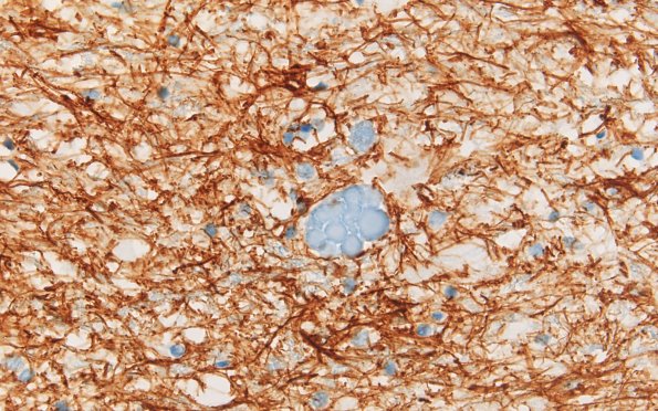 24A2 Gracile NAD (Case 37) A8 GFAP  60X